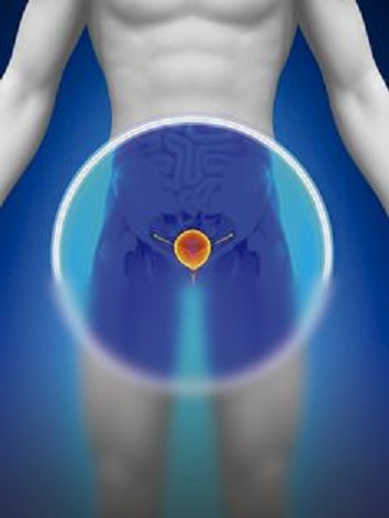 Importante acudir a revisión médica periódica para detectar a tiempo el cáncer de próstata