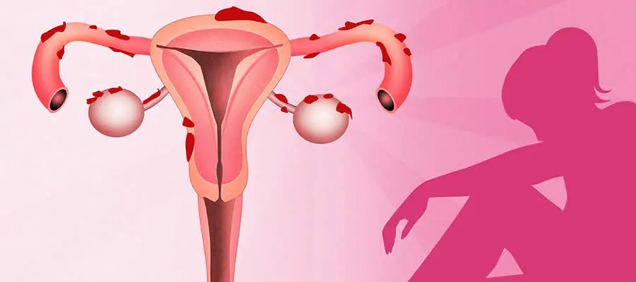 SESA se suma al Día Mundial de la Endometriosis