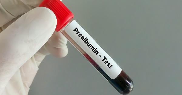 Análisis de sangre de prealbúmina, ¿qué es y para qué lo utilizan los médicos?
