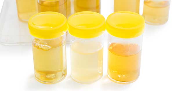 Color de la orina, ¿Qué dice sobre la salud del tracto urinario?