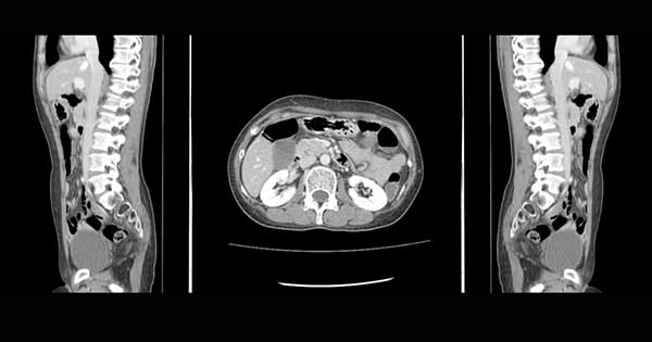 Tomografía computarizada de abdomen y pelvis, lo que debes saber