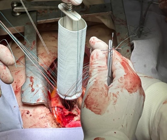 Realiza SESA con éxito procedimiento de cirugía a corazón abierto en el Hospital General de Querétaro