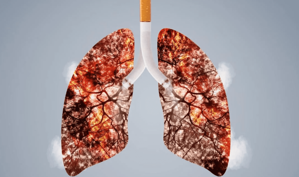 Mayoría de los casos de cáncer de pulmón se relaciona con consumo de tabaco